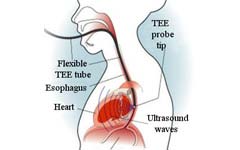 3-transesophageal-echocardiogram
