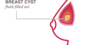 Breast cyst