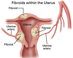 Fibroma