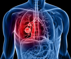 Lung tumors