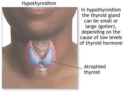 adm_hypothyroidism