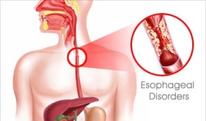 esophageal-disorders